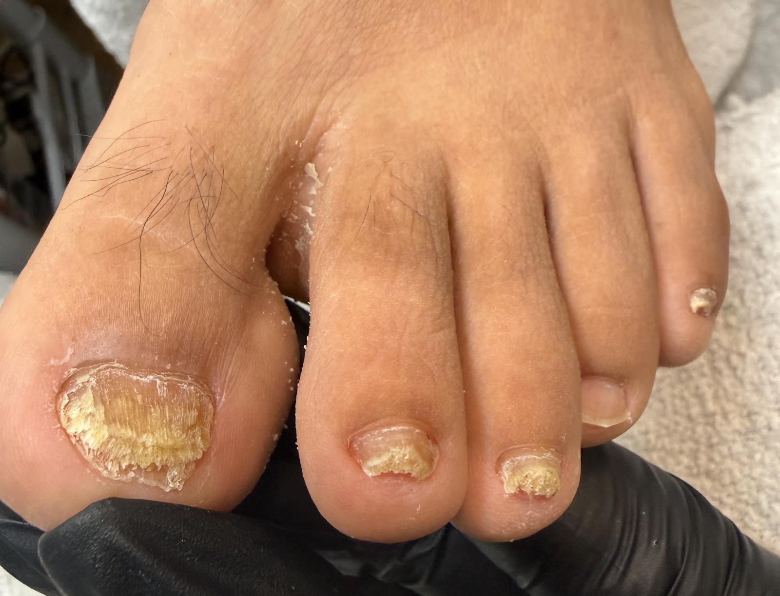 Why Is My Toenail Thick, Yellow, or Falling Off? Here